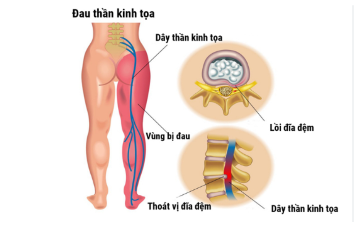 Tho&aacute;t vị đĩa đệm L4 L5 l&agrave; nguy&ecirc;n nh&acirc;n h&agrave;ng đầu g&acirc;y đau thần kinh tọa