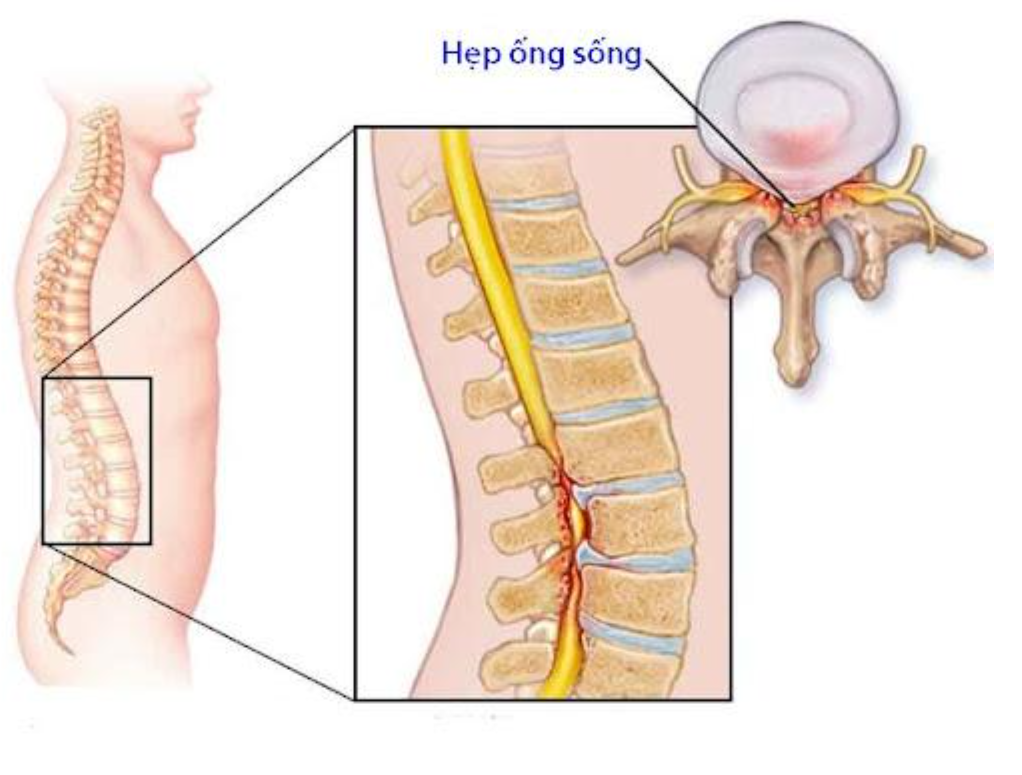 Hẹp ống sống thắt lưng - Biến chứng nguy hiểm của tho&aacute;t vị đĩa đệm L4 L5