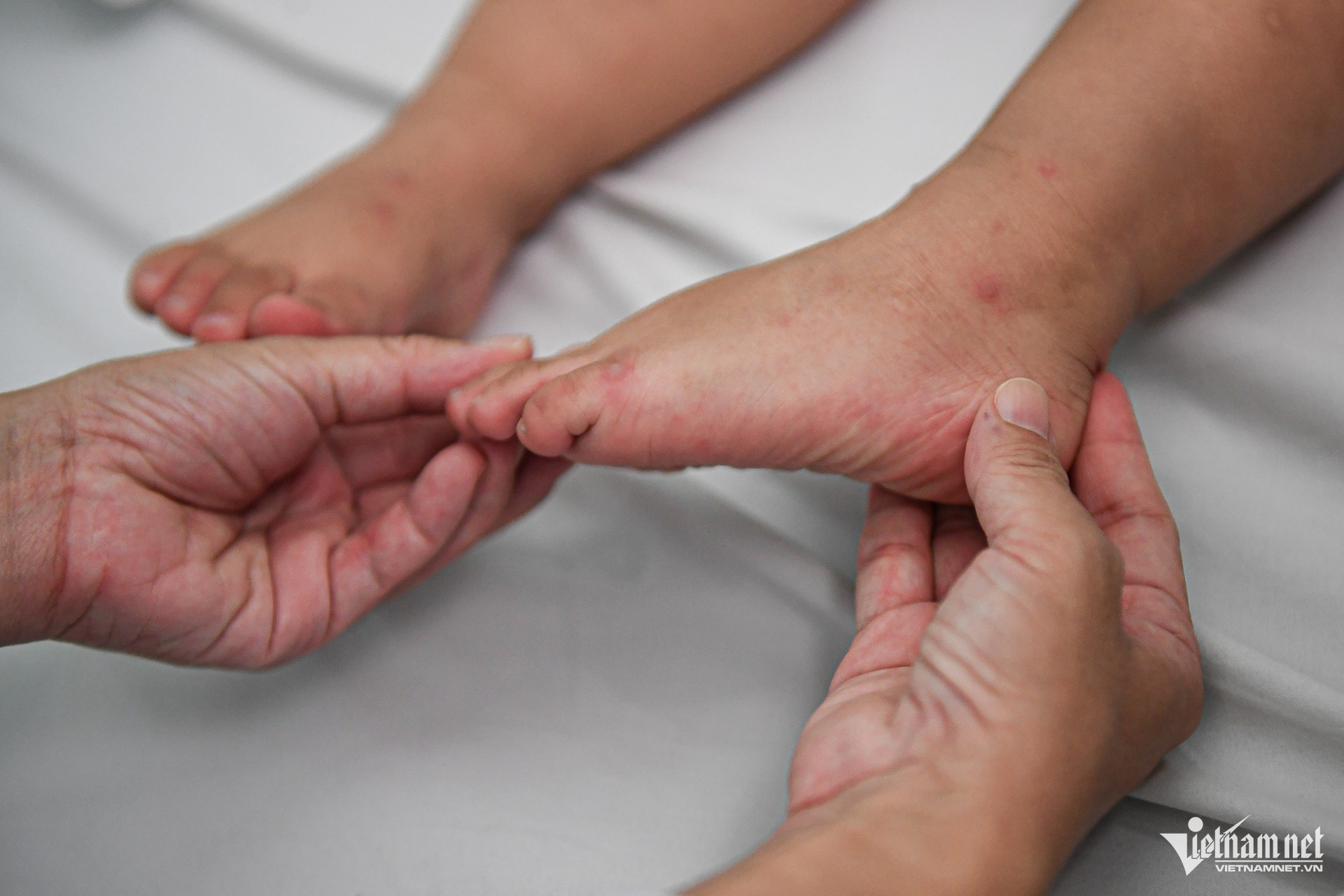 Theo b&aacute;c sĩ Dương, bệnh tay ch&acirc;n miệng thường gặp ở trẻ dưới 5 tuổi, nh&oacute;m nguy cơ nặng nhất l&agrave; trẻ dưới 3 tuổi do hệ miễn dịch chưa c&oacute; khả năng chống lại chủng virus n&agrave;y. Ảnh: B&aacute;o Vietnamnet