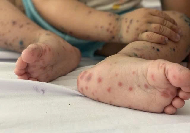 Bộ Y tế y&ecirc;u cầu chủ động ngăn chặn dịch tay ch&acirc;n miệng. Ảnh minh họa