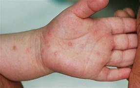 Hà Nội tăng cường phòng, chống bệnh tay chân miệng và các dịch truyền nhiễm