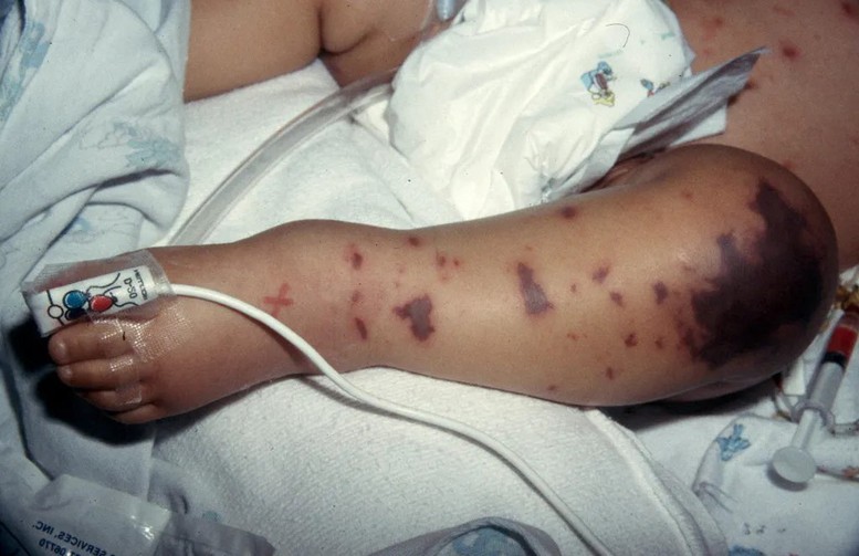 Dấu hiệu ban điển h&igrave;nh tr&ecirc;n da của trẻ mắc vi&ecirc;m m&agrave;ng n&atilde;o m&ocirc; cầu