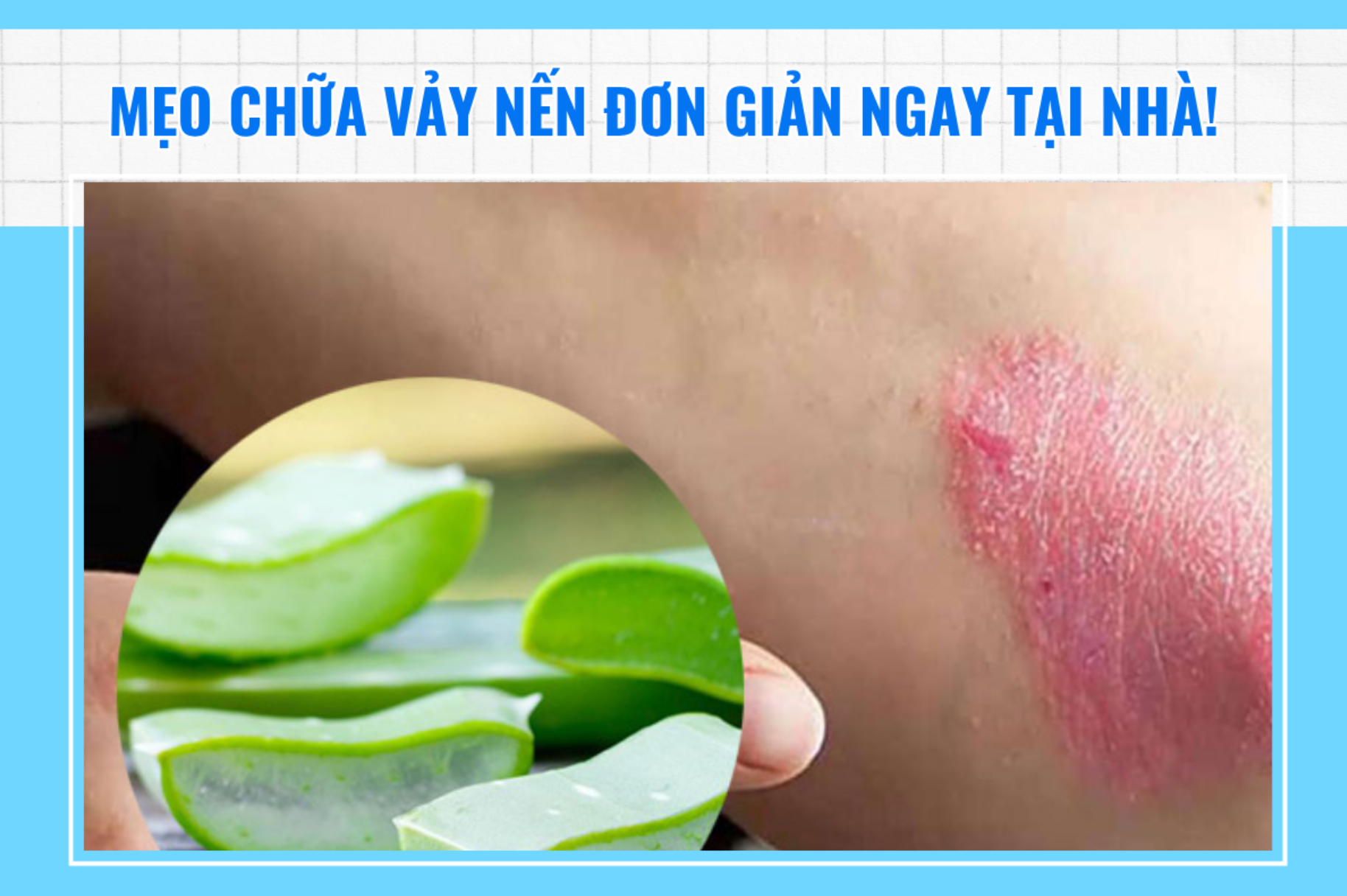 Mẹo chữa vảy nến đơn giản ngay tại nhà!
