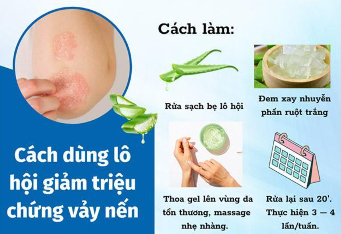 D&ugrave;ng l&ocirc; hội gi&uacute;p giảm nhẹ triệu chứng vảy nến