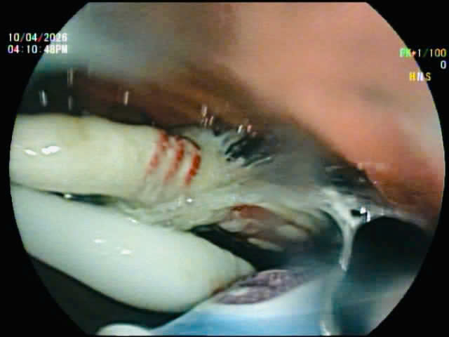 b&agrave;n chải đảnh răng nằm trong ổ bụng