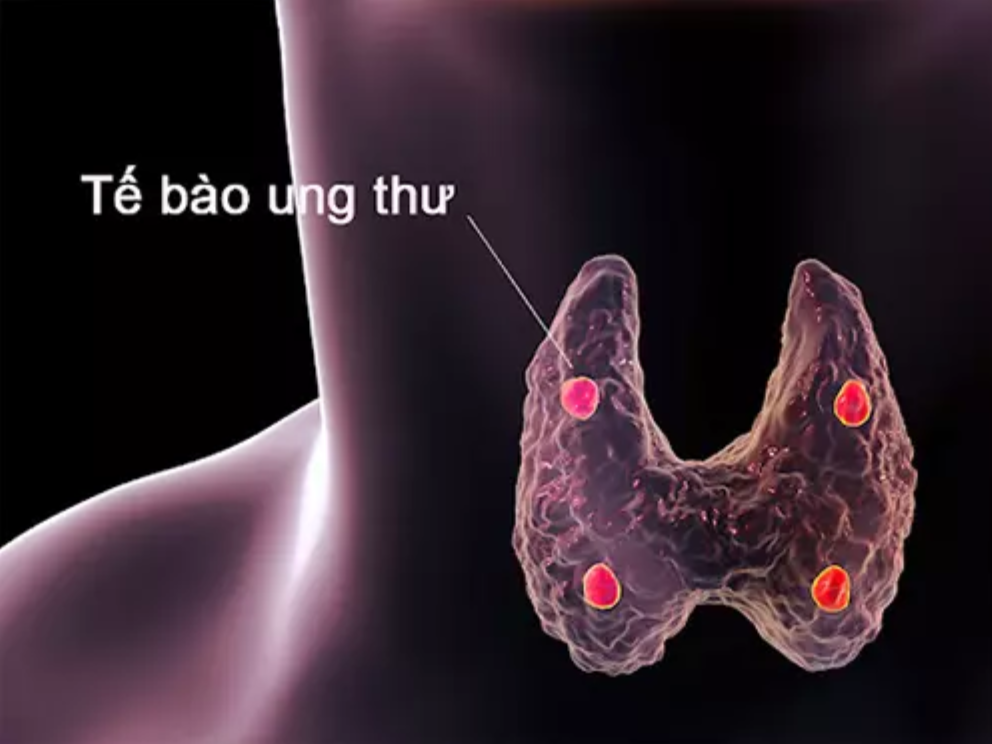 C&aacute;c tế b&agrave;o ung thư tuyến gi&aacute;p tăng sản xuất hormone sẽ g&acirc;y ra c&aacute;c triệu chứng cường gi&aacute;p