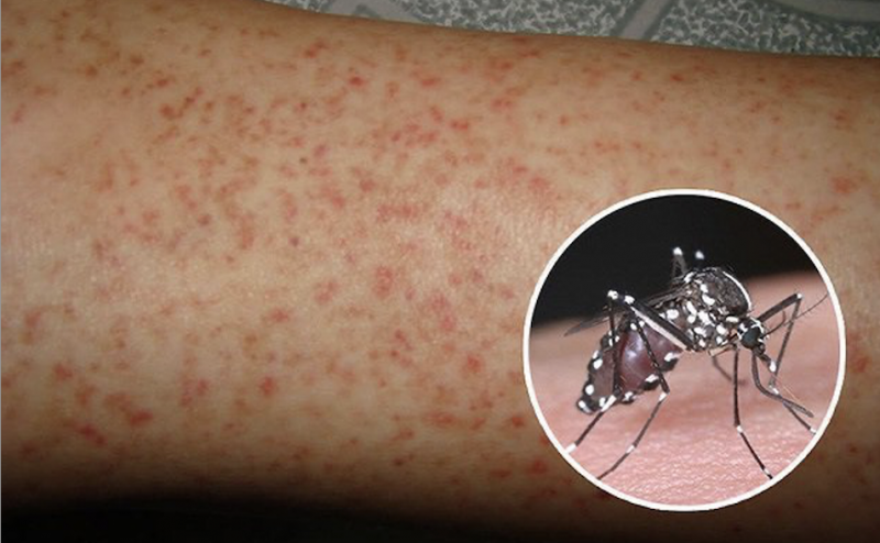 Sốt xuất huyết vào mùa: Cảnh báo nguy cơ bùng phát, cần kiểm soát ngay từ sớm