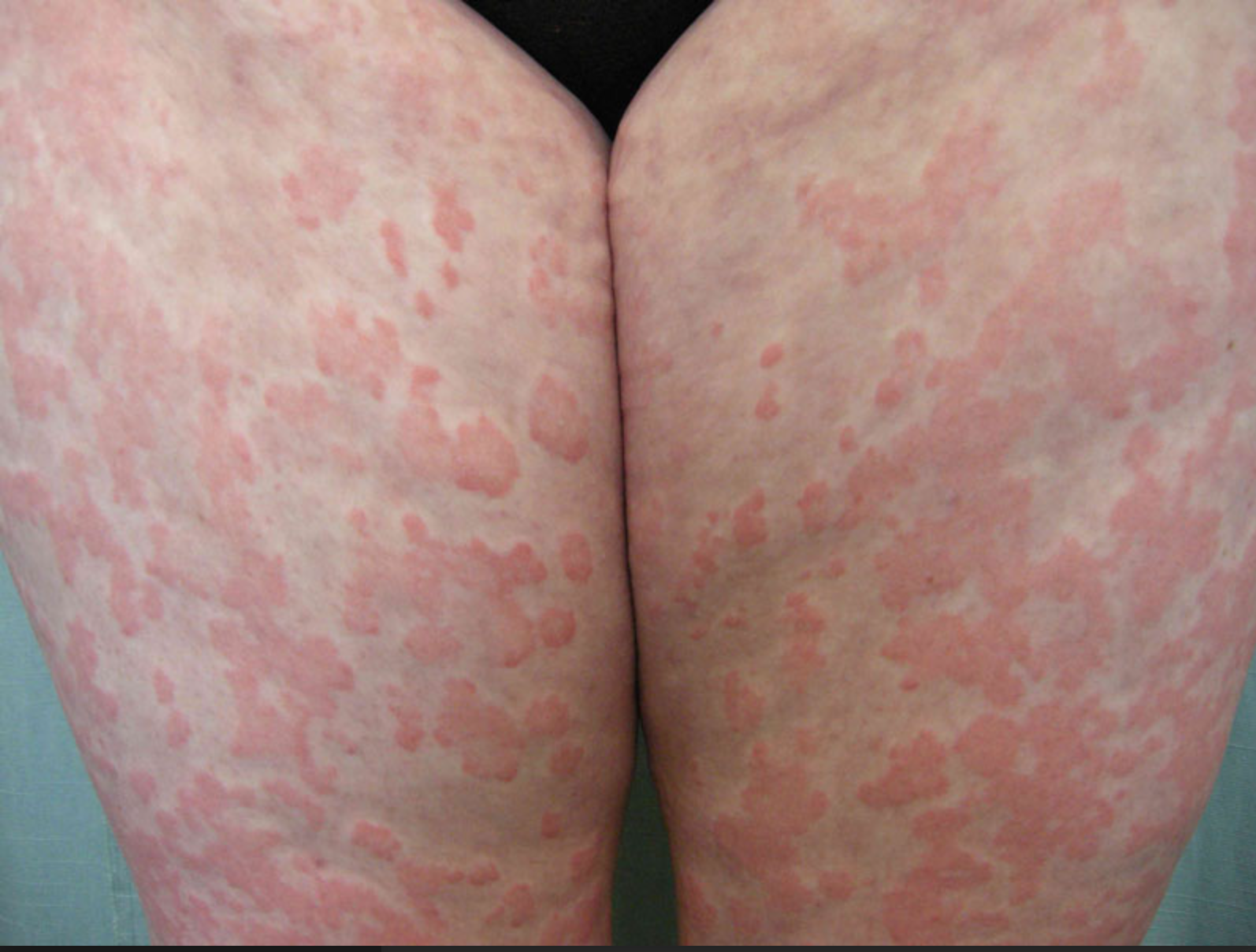 Thức khuya, thiếu ngủ kéo dài khiến mề đay bùng phát