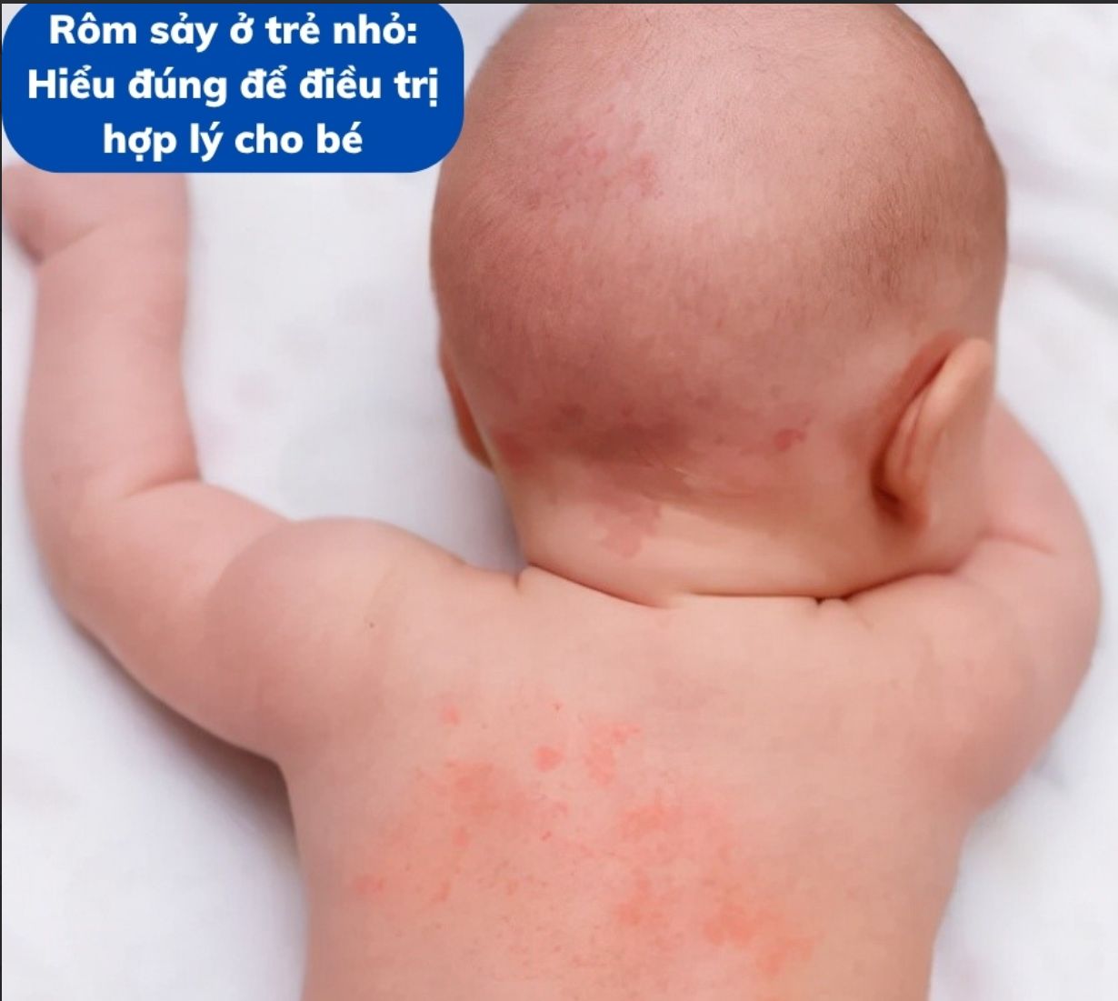 Rôm sảy ở trẻ nhỏ: Hiểu đúng để điều trị hiệu quả