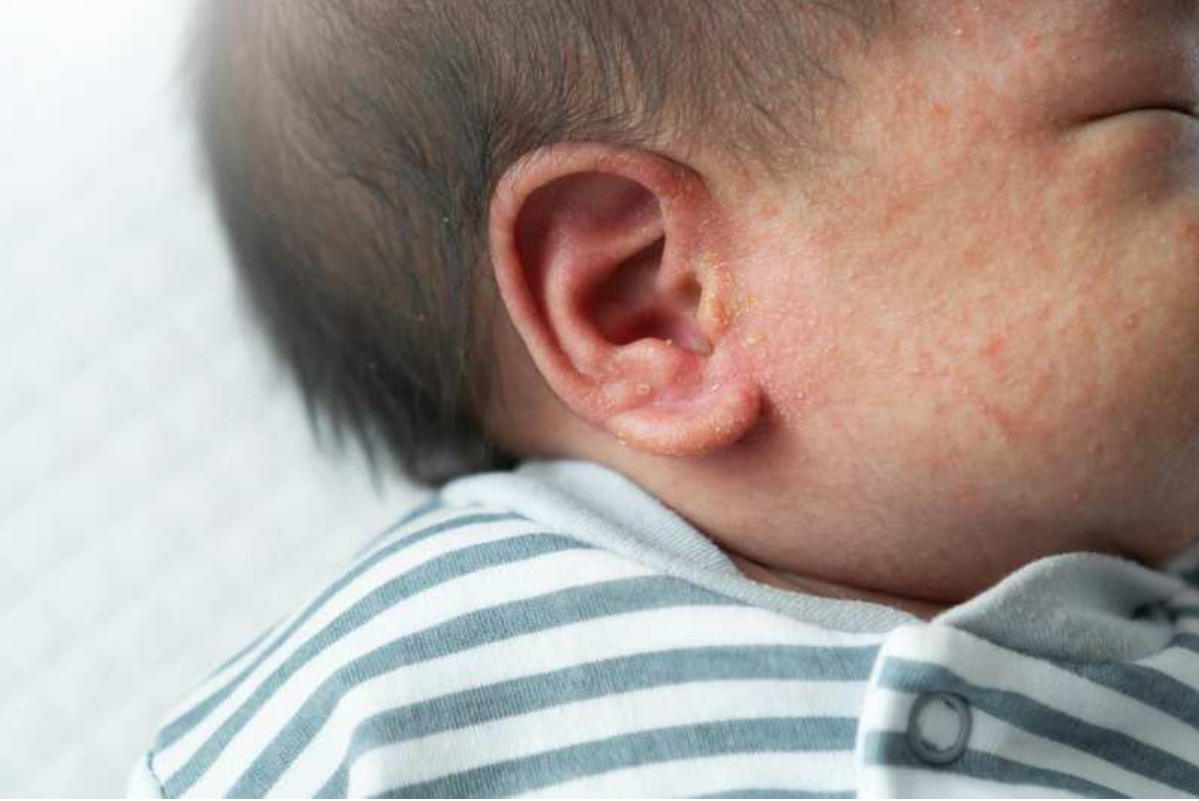 C&oacute; nhiều yếu tố l&agrave;m tăng nguy cơ r&ocirc;m sảy ở trẻ