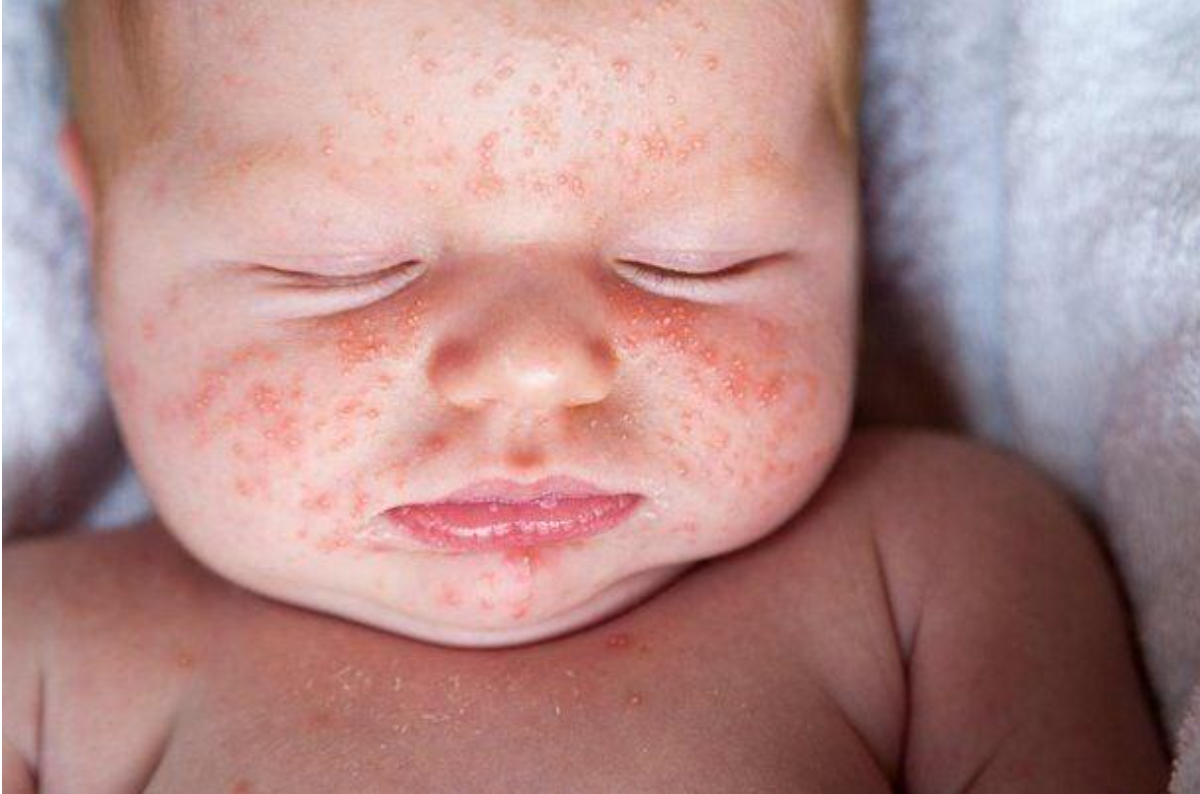 R&ocirc;m sảy ở trẻ thường khởi ph&aacute;t &acirc;m thầm n&ecirc;n dễ bị bỏ qua