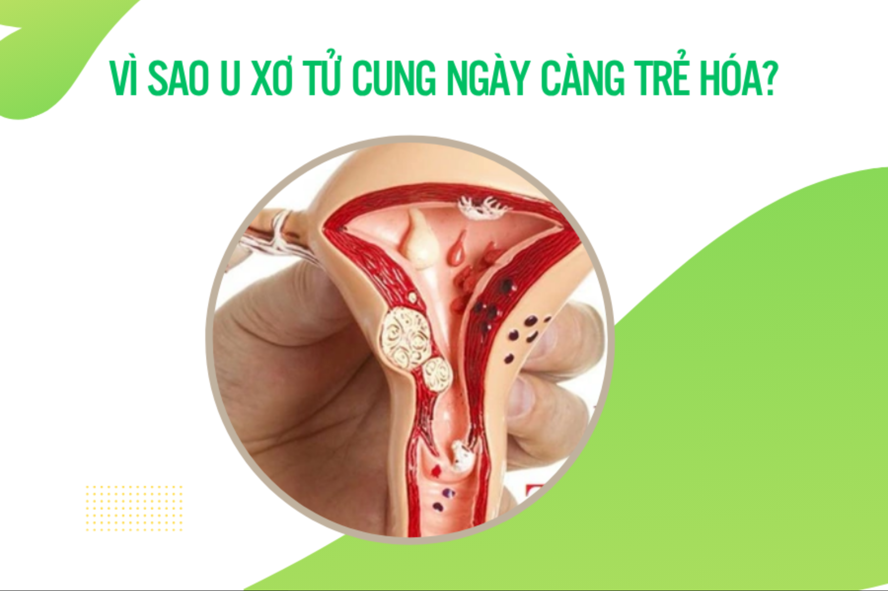 Vì sao u xơ tử cung ngày càng trẻ hóa?