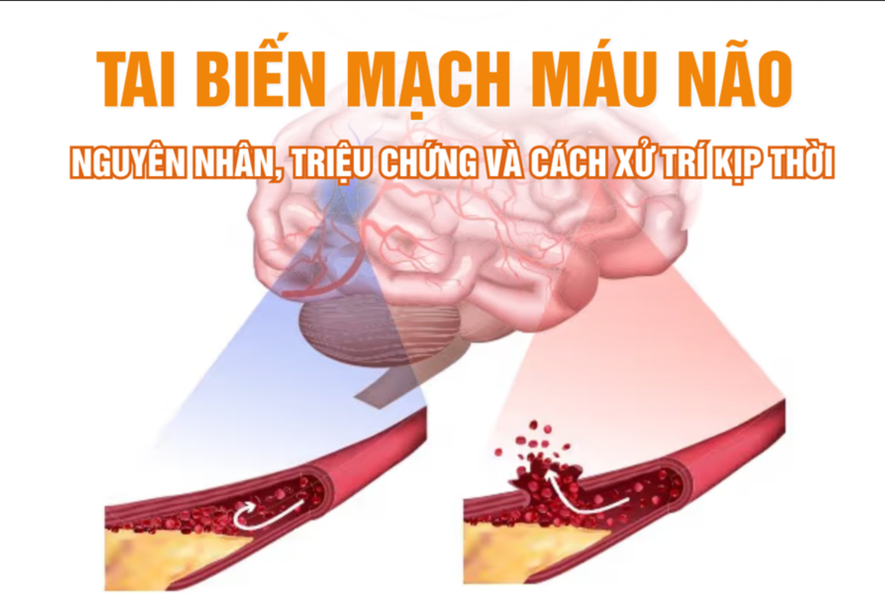 Tai biến mạch máu não: Nguyên nhân, triệu chứng và cách xử trí kịp thời