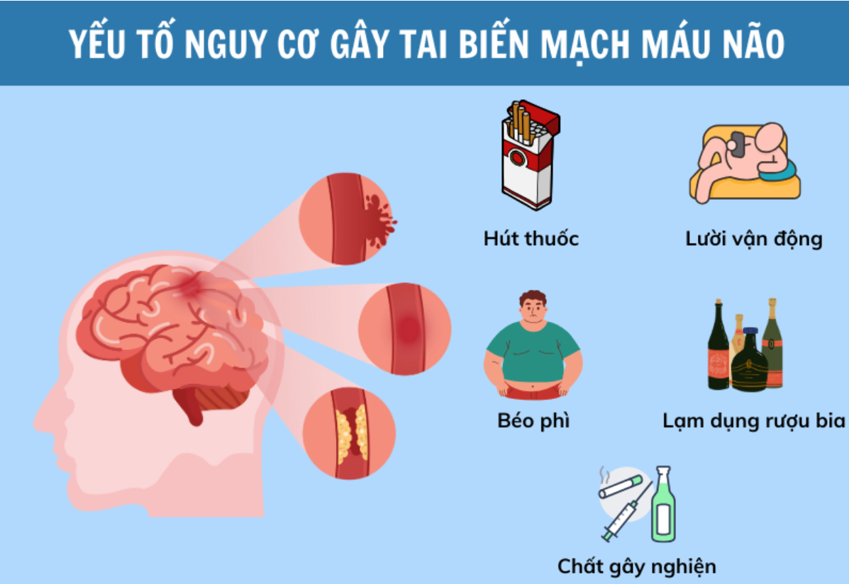 Th&oacute;i quen sống kh&ocirc;ng l&agrave;nh mạnh c&oacute; thể l&agrave;m tăng nguy cơ tai biến mạch m&aacute;u n&atilde;o