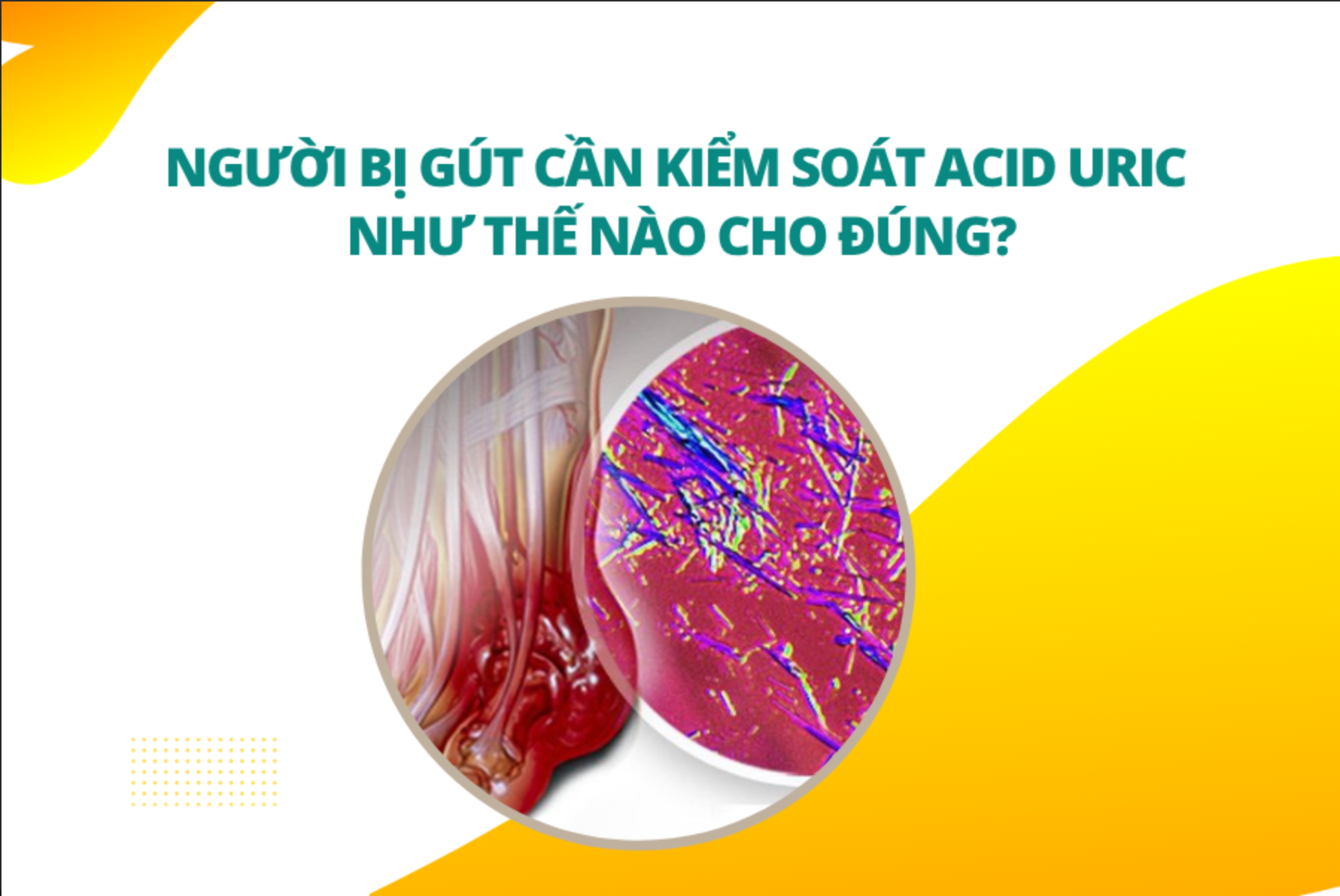 Người bị gút cần kiểm soát acid uric như thế nào cho đúng?