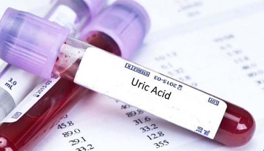 Acid uric tăng cao k&eacute;o d&agrave;i sẽ khiến cho bệnh g&uacute;t nặng nề hơn