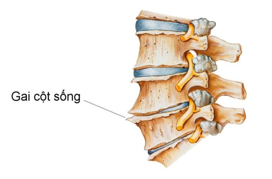 Tho&aacute;i h&oacute;a đốt sống l&acirc;u ng&agrave;y dẫn đến bệnh gai đốt sống