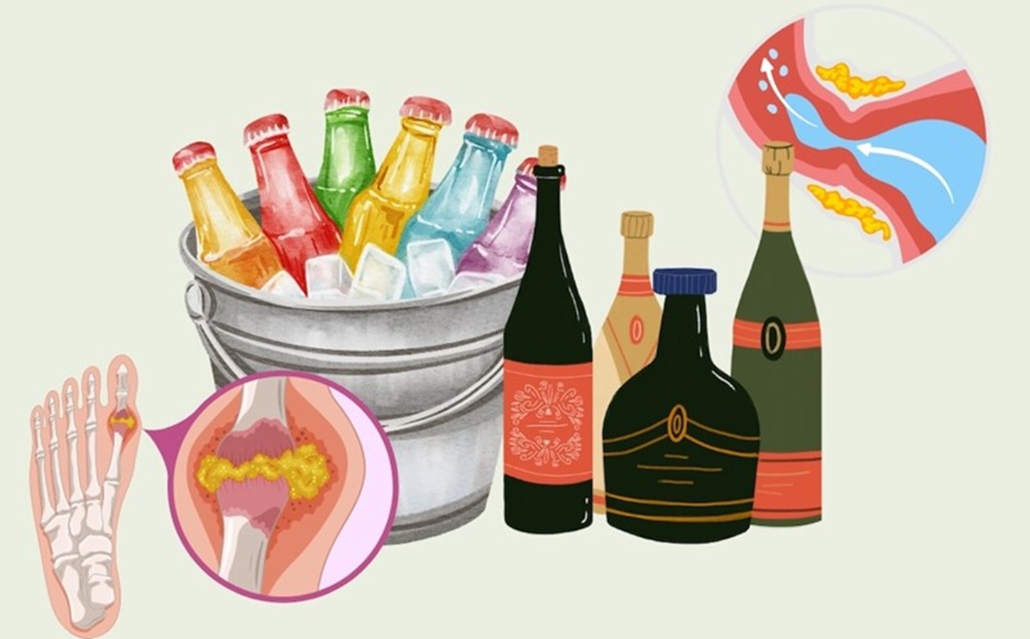 Cảnh báo 5 loại đồ uống làm tăng axit uric gây nguy cơ bệnh gout