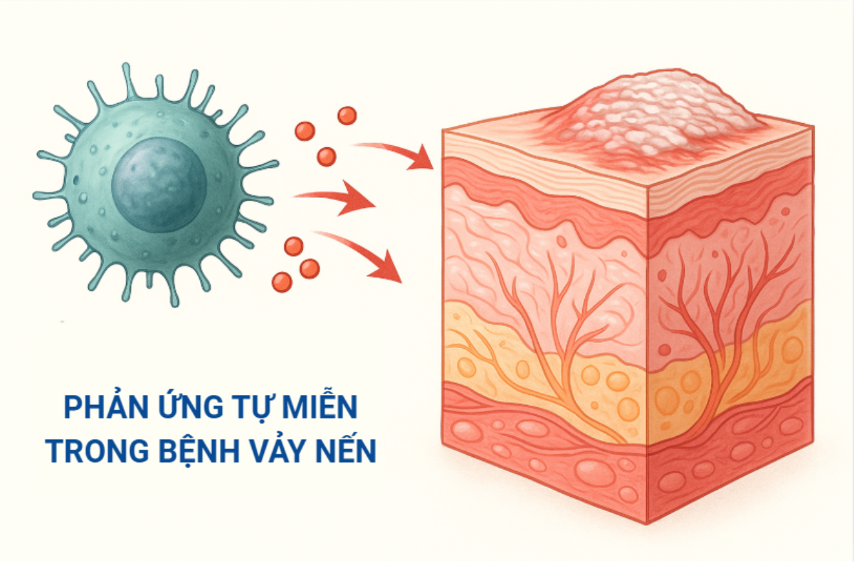 Vảy nến bản chất là bệnh tự miễn mạn tính Vảy nến bản chất là bệnh tự miễn mạn tính