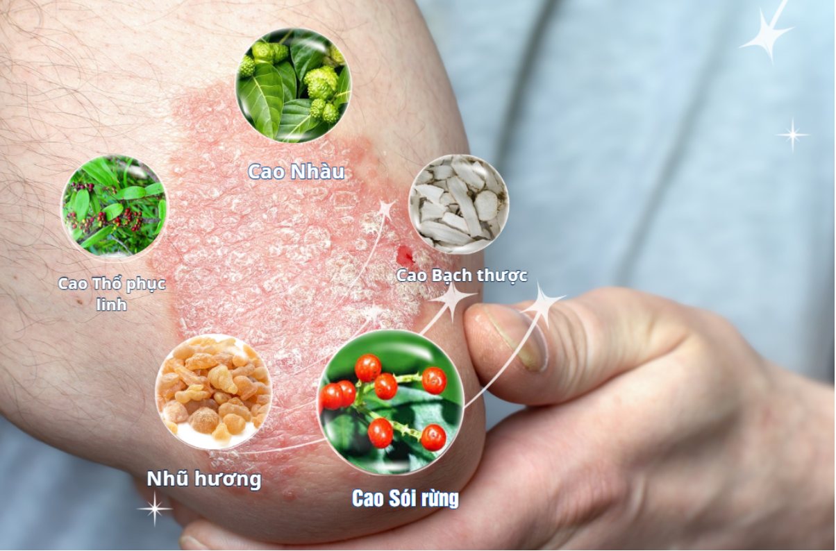 Thảo dược giúp tăng miễn dịch, giảm viêm trong bệnh vảy nến Thảo dược giúp tăng miễn dịch, giảm viêm trong bệnh vảy nến