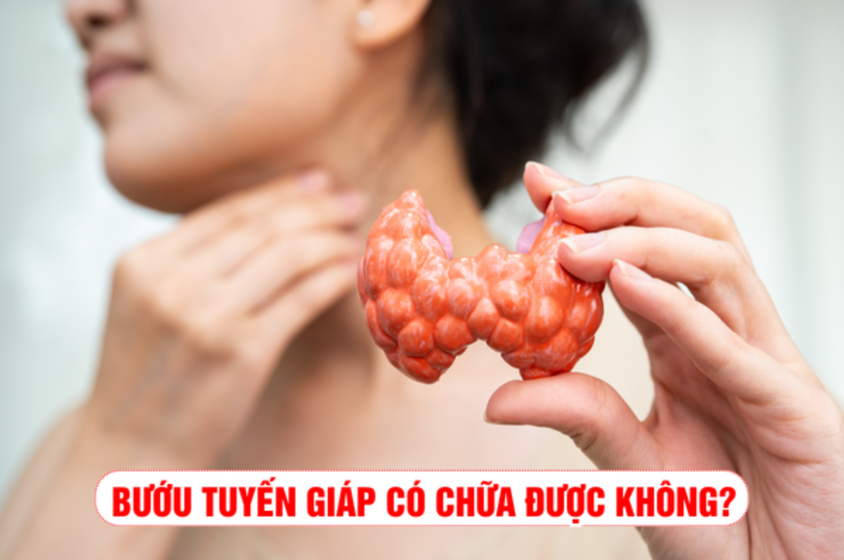 Bướu tuyến giáp có chữa được không? 