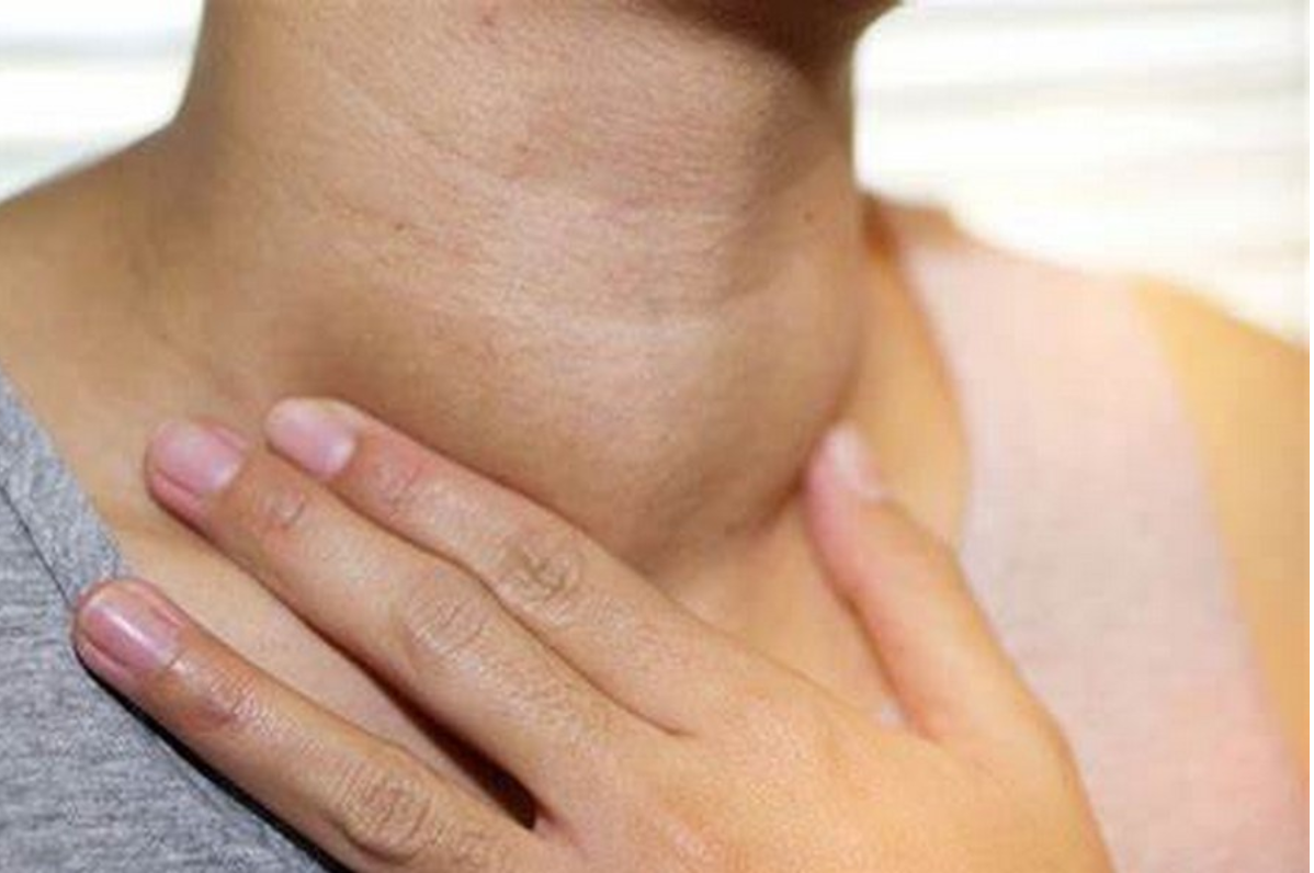 Tuyến giáp phì đại gây bướu và rối loạn hormone Tuyến giáp phì đại gây bướu và rối loạn hormone