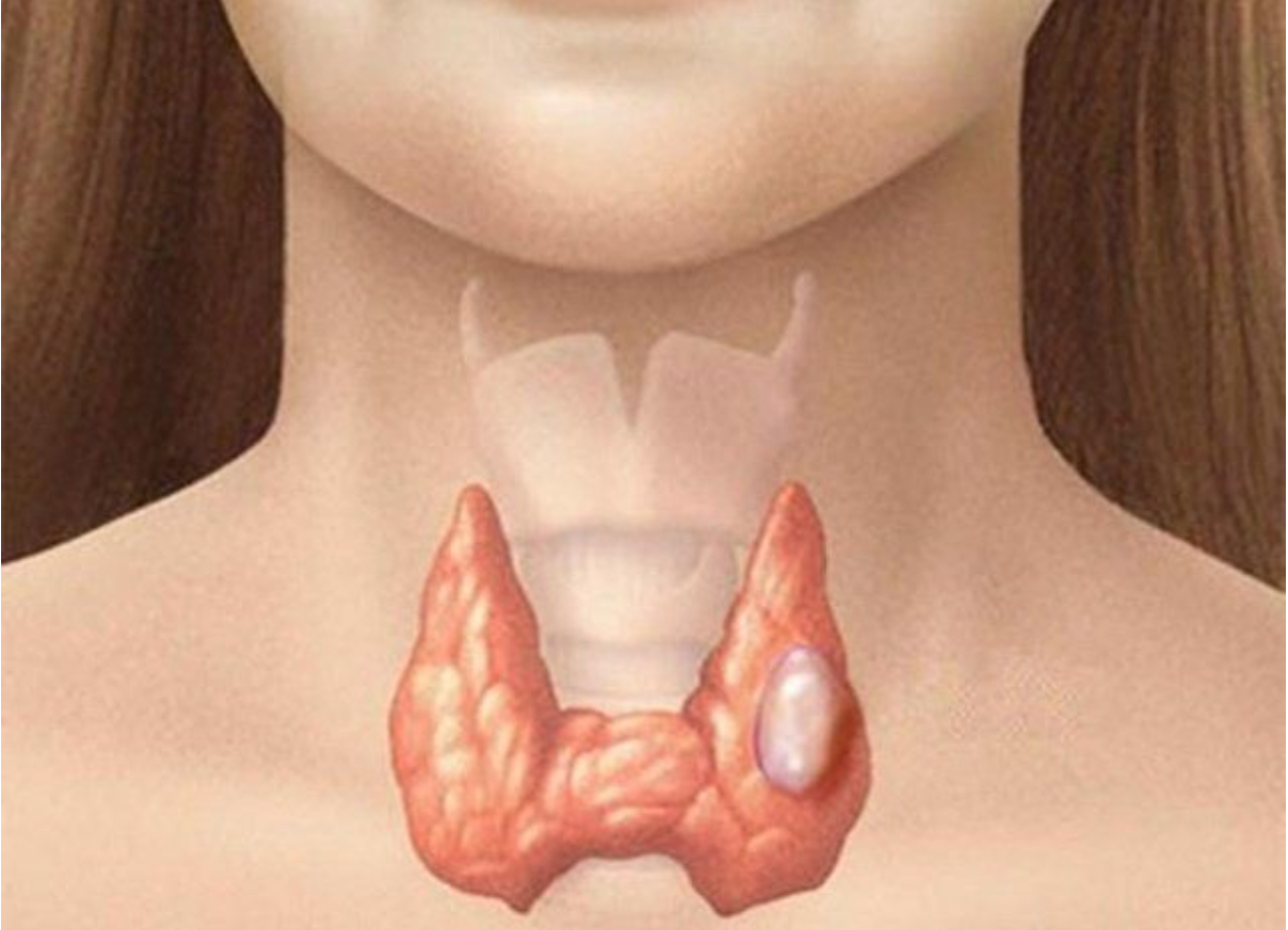 Bướu tuyến giáp cần điều trị khi kích thước lớn, phát triển nhanh hoặc gây rối loạn hormone Bướu tuyến giáp cần điều trị khi kích thước lớn, phát triển nhanh hoặc gây rối loạn hormone