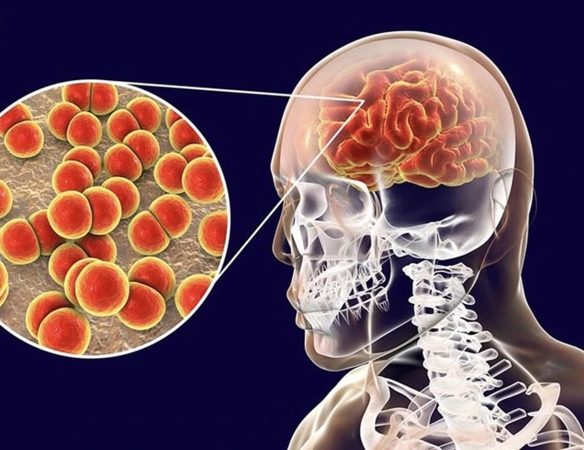 Báo động số ca mắc não mô cầu tăng mạnh, chuyên gia cảnh báo chuỗi di chứng nặng nề