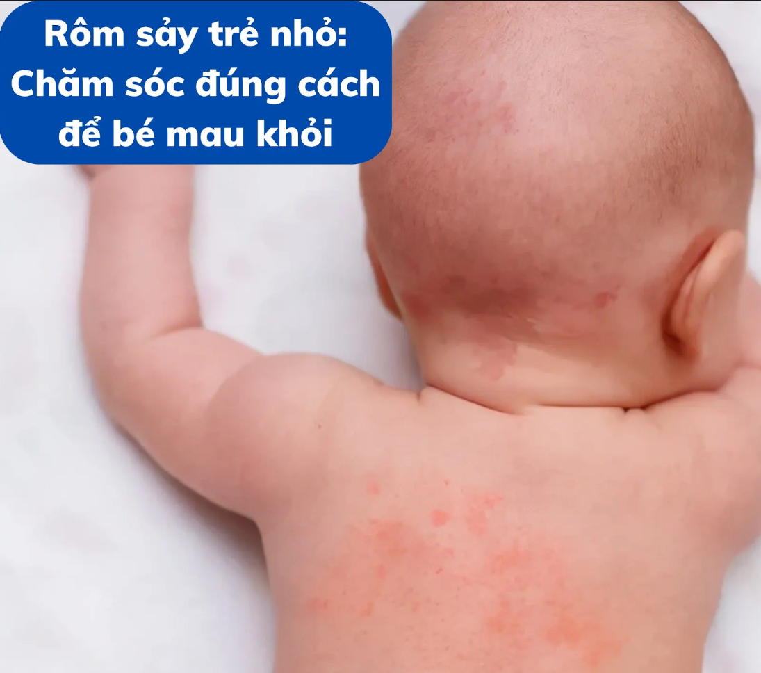 Rôm sảy trẻ nhỏ: Chăm sóc đúng cách để bé mau khỏi