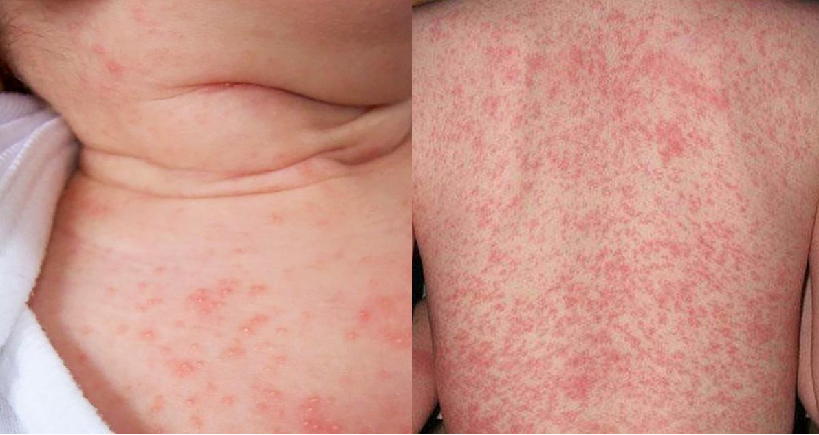 R&ocirc;m sảy l&agrave; t&igrave;nh trạng thường gặp ở trẻ nhỏ