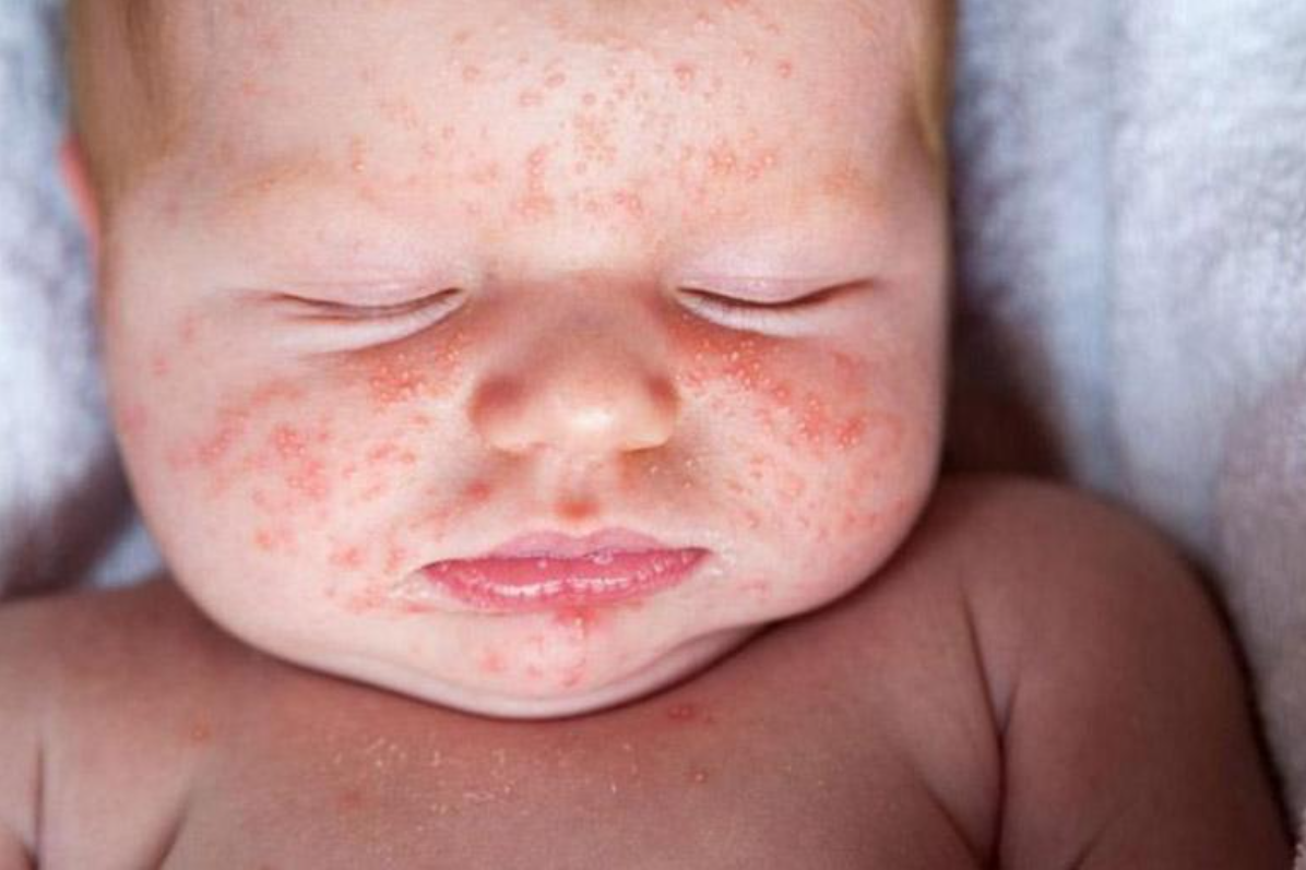 Muốn cải thiện r&ocirc;m sảy, cần giữ cơ thể trẻ kh&ocirc;ng bị qu&aacute; n&oacute;ng
