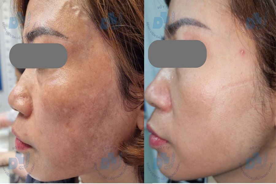 Bác sĩ da liễu lý giải vì sao nhiều người trị nám tốn kém nhưng vẫn tái phát