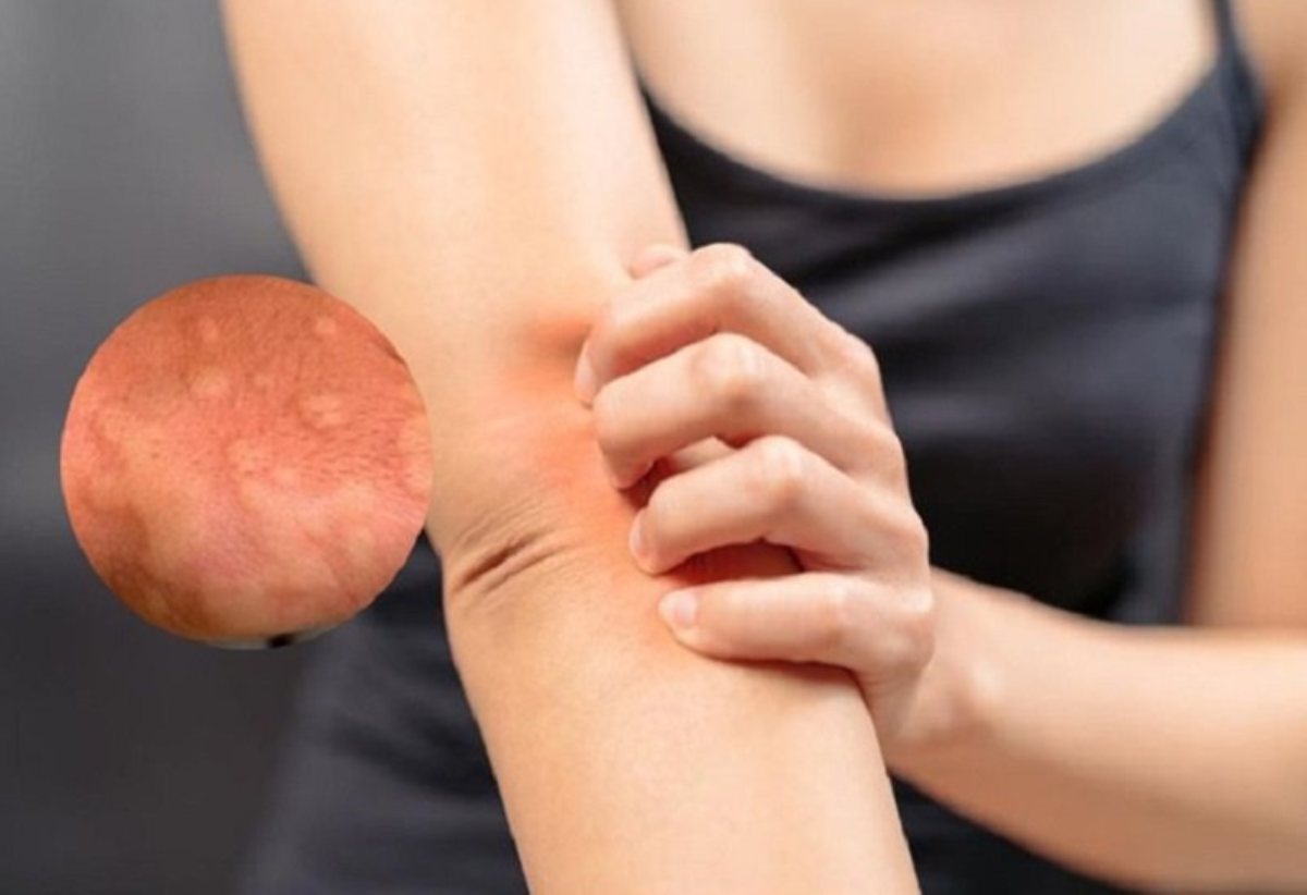 Ngứa do mề đay, dị ứng thường xuất hiện sau thời gian d&agrave;i tắm sai c&aacute;ch