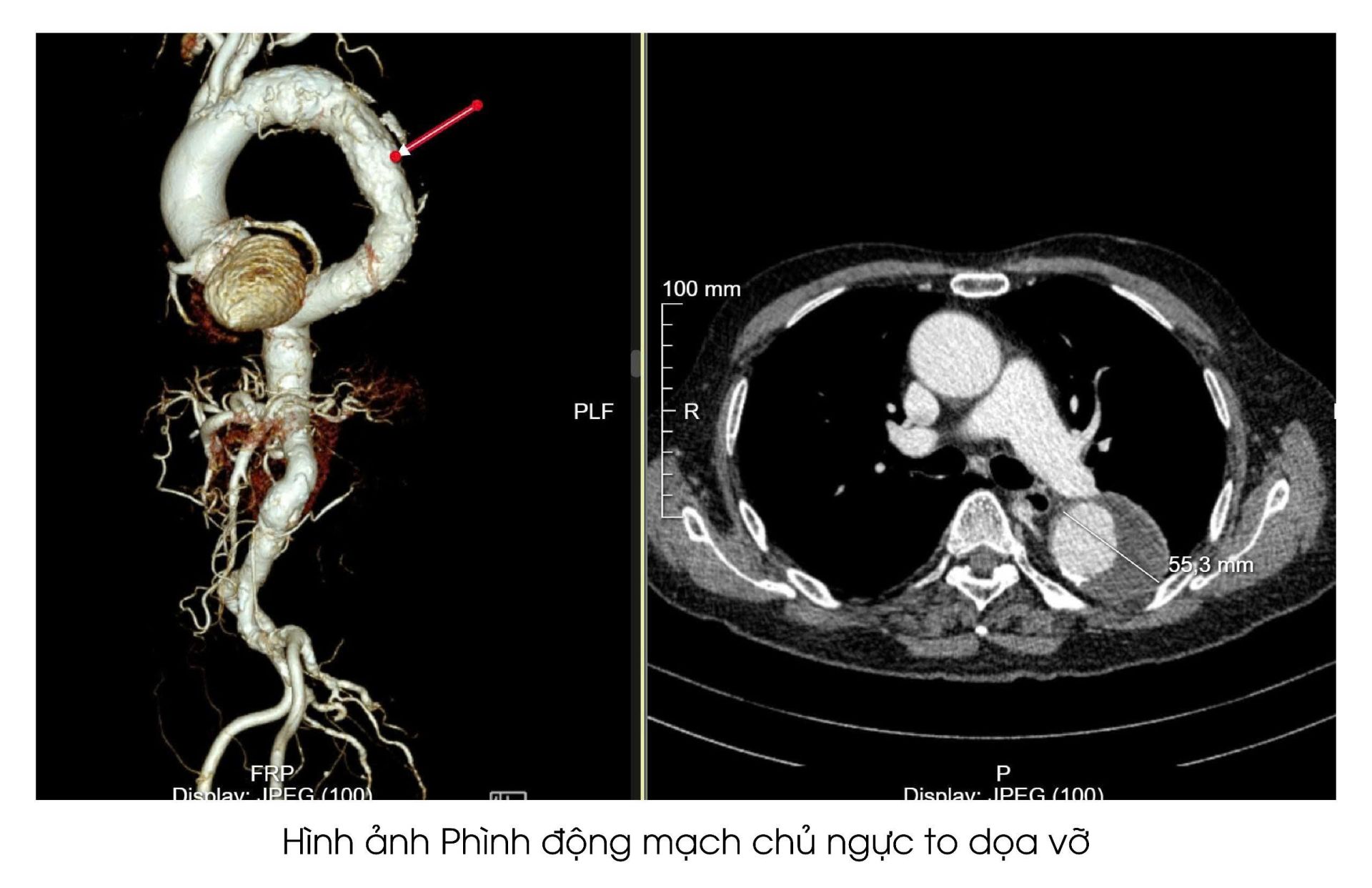 H&igrave;nh ảnh Ph&igrave;nh động mạch chủ ngực to dọa vỡ của cụ &ocirc;ng 94 tuổi
