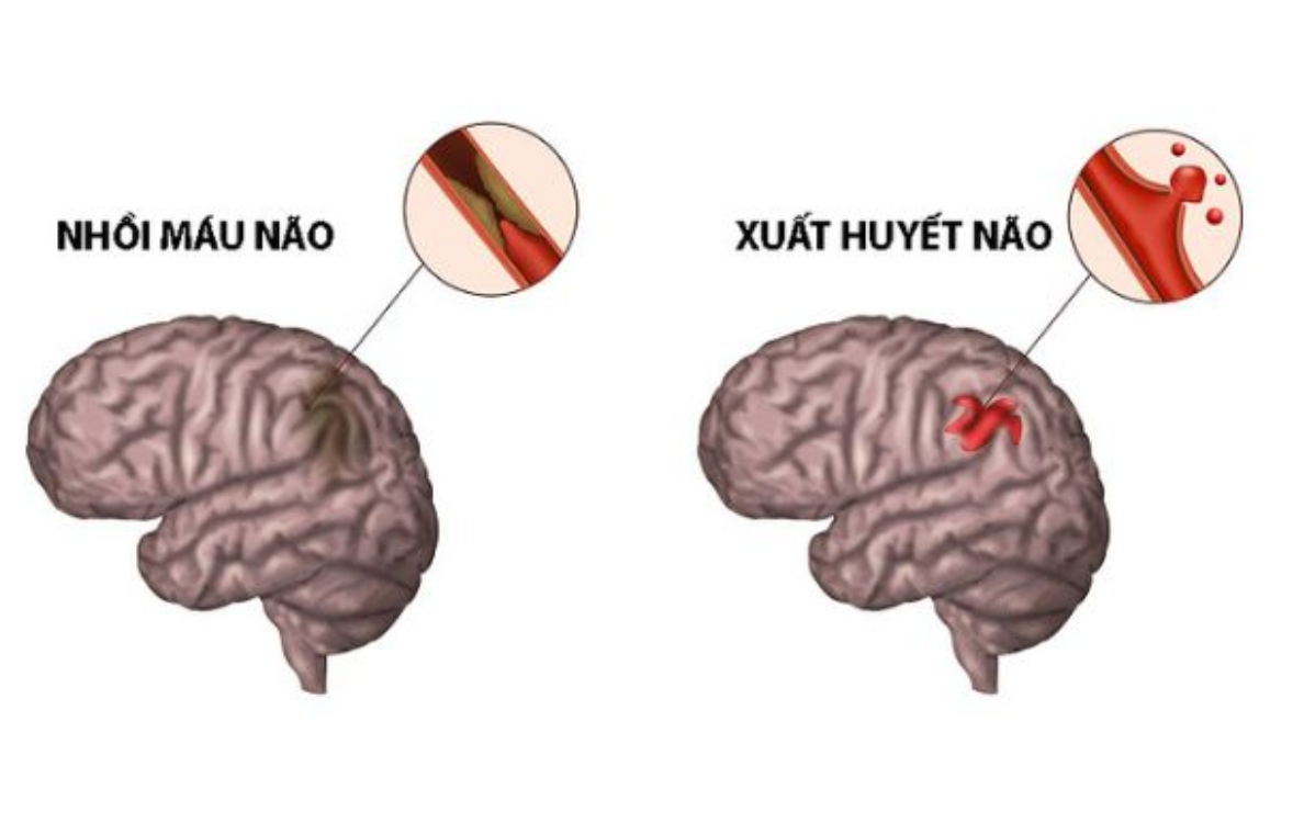 Tai biến được chia th&agrave;nh hai nh&oacute;m ch&iacute;nh l&agrave; nhồi m&aacute;u n&atilde;o v&agrave; xuất huyết n&atilde;o