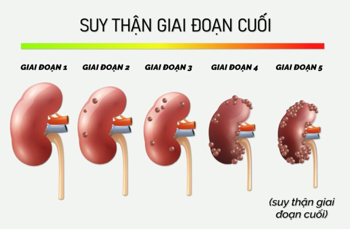 Suy thận giai đoạn cuối là khi thận đã không còn khả năng hoạt động hiệu quả Suy thận giai đoạn cuối là khi thận đã không còn khả năng hoạt động hiệu quả