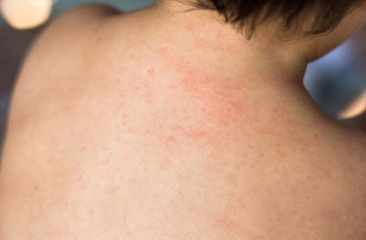 R&ocirc;m sảy xuất hiện khi c&aacute;c ống tuyến mồ h&ocirc;i bị b&iacute;t tắc