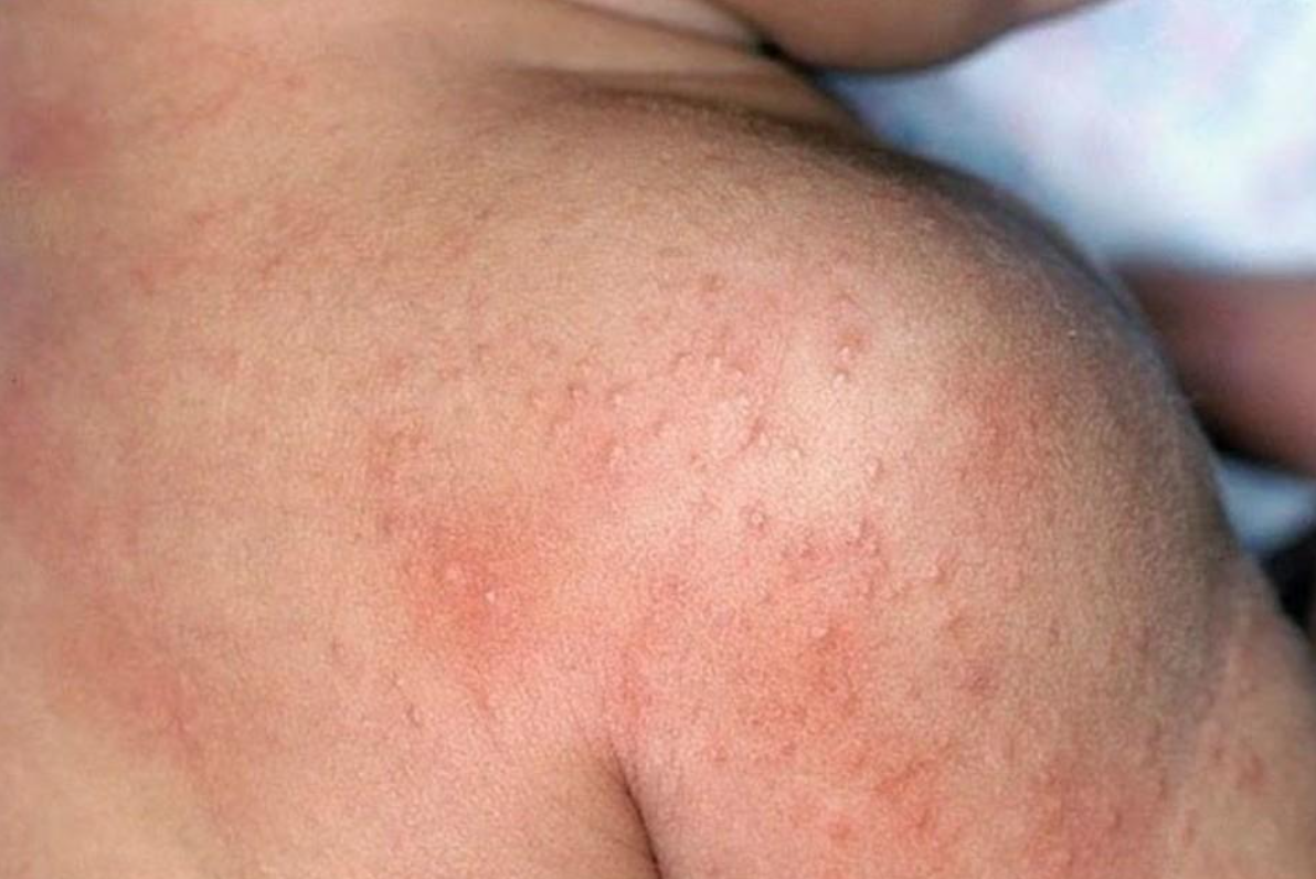 R&ocirc;m sảy khiến b&eacute; ngứa ng&aacute;y, kh&oacute; chịu