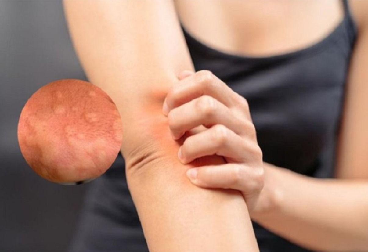 Ngứa do mề đay, dị ứng thường xuất hiện ở người làm văn phòng ngồi điều hòa cả ngày Ngứa do mề đay, dị ứng thường xuất hiện ở người làm văn phòng ngồi điều hòa cả ngày