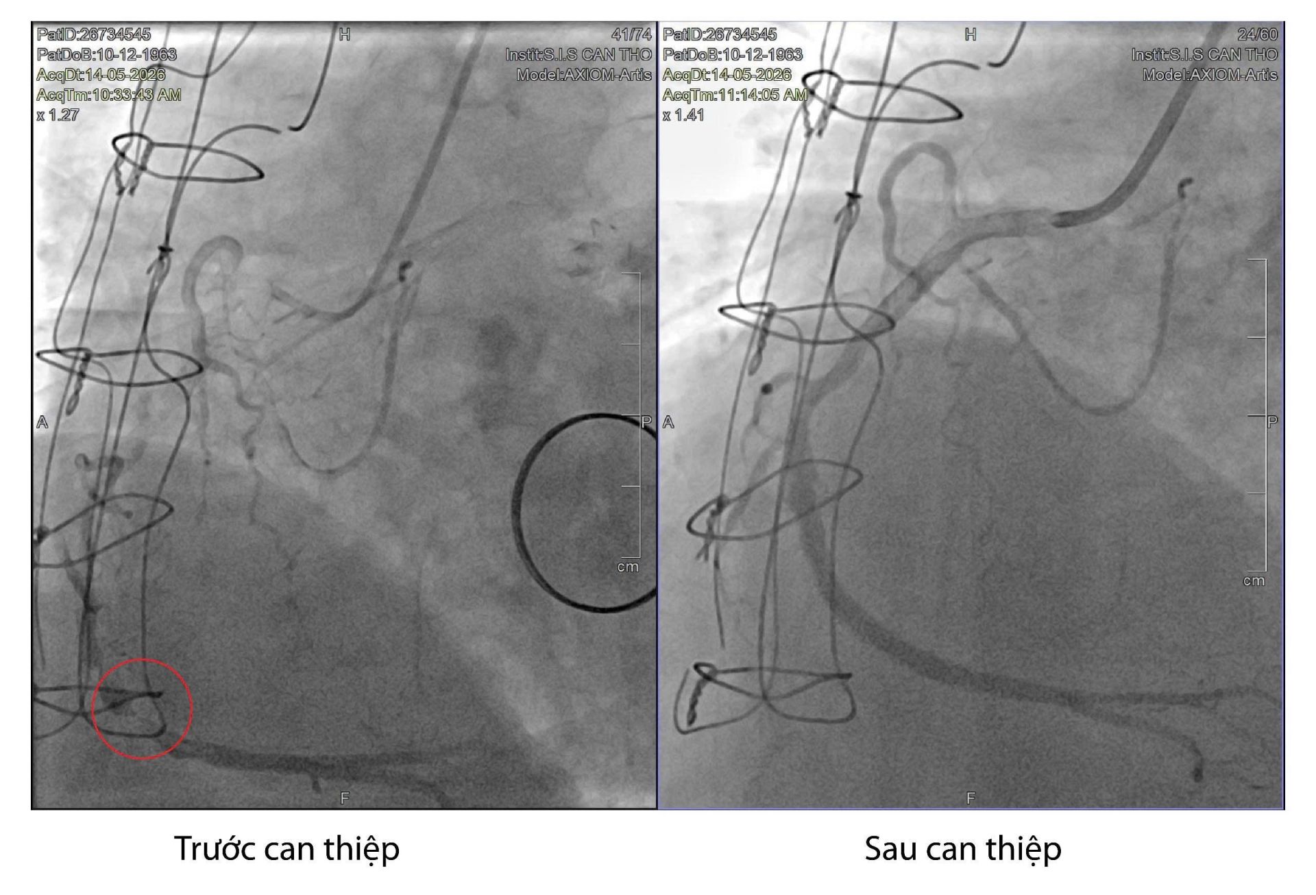 Cần Thơ: Cứu sống một bệnh nhân suy tim cấp bằng 4 stent tái thông hoàn toàn hệ mạch vành