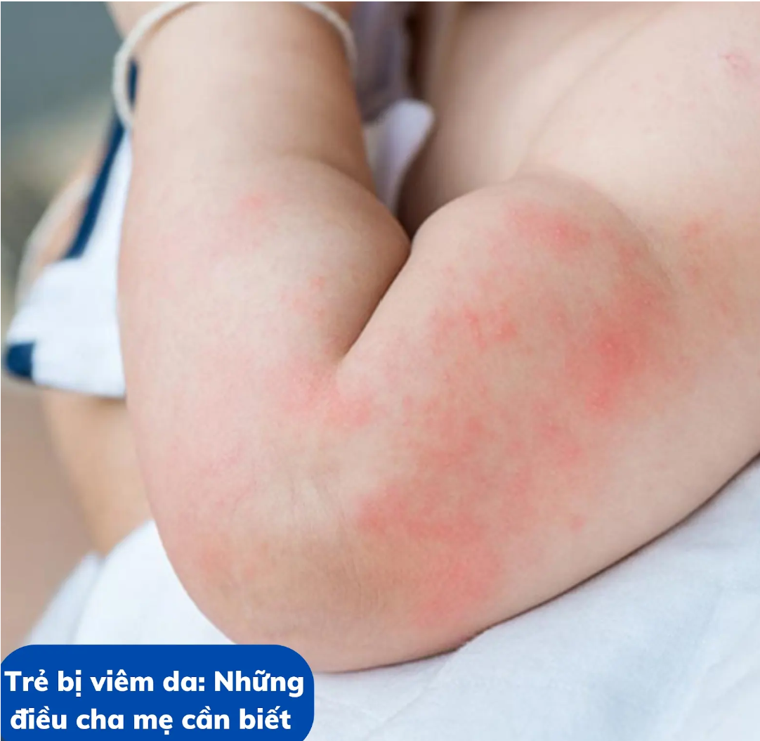 Trẻ bị viêm da: Những điều cha mẹ cần biết 
