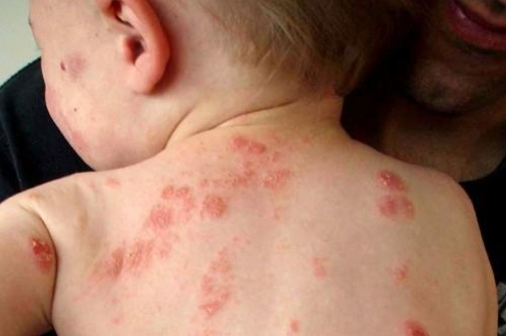 Viêm da xuất hiện ngày càng phổ biến ở trẻ Viêm da xuất hiện ngày càng phổ biến ở trẻ
