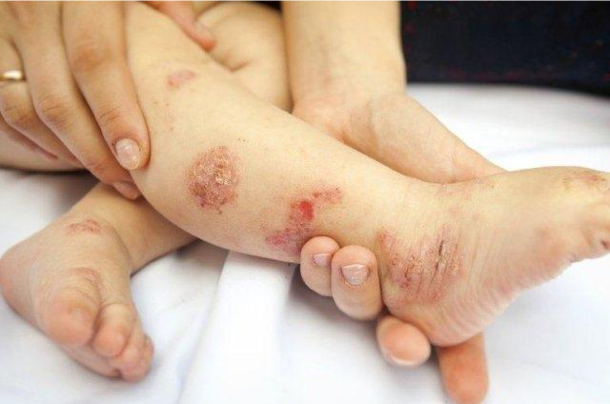 Viêm da ở trẻ thường khởi phát âm thầm nên dễ bị bỏ qua Viêm da ở trẻ thường khởi phát âm thầm nên dễ bị bỏ qua