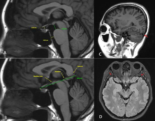 Ảnh 1: MRI sọ n&atilde;o lần 3 ghi nhận nhiều dấu hiệu gợi &yacute; hội chứng giảm &aacute;p lực nội sọ do r&ograve; dịch n&atilde;o tủy, bao gồm: n&atilde;o sa thấp nhẹ, c&aacute;c khoang dịch quanh n&atilde;o thu hẹp, gi&atilde;n c&aacute;c xoang tĩnh mạch nội sọ v&agrave; d&agrave;y nhẹ m&agrave;ng n&atilde;o.