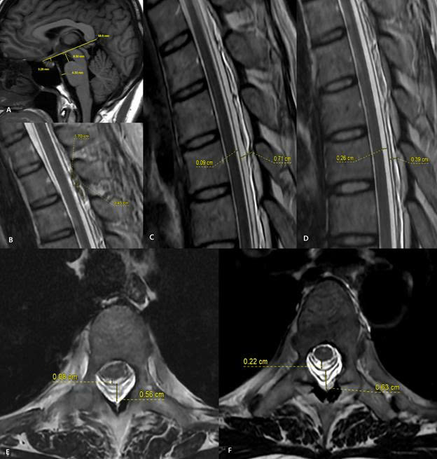 Ảnh 2: H&igrave;nh ảnh MRI trước v&agrave; sau thủ thuật v&aacute; m&aacute;u ngo&agrave;i m&agrave;ng cứng (EBP). Sau điều trị, khoang chứa dịch n&atilde;o tủy quanh tủy sống được mở rộng trở lại, trong khi khoang ngo&agrave;i m&agrave;ng cứng thu hẹp r&otilde; rệt. Những thay đổi n&agrave;y cho thấy &aacute;p lực dịch n&atilde;o tủy đ&atilde; được cải thiện sau thủ thuật.