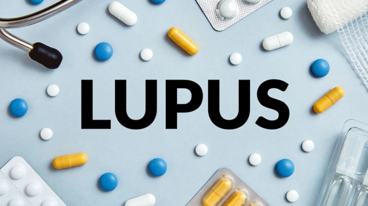 Điều trị lupus ban đỏ hiện nay vẫn chủ yếu tập trung kiểm soát viêm và hạn chế tổn thương cơ quan Điều trị lupus ban đỏ hiện nay vẫn chủ yếu tập trung kiểm soát viêm và hạn chế tổn thương cơ quan