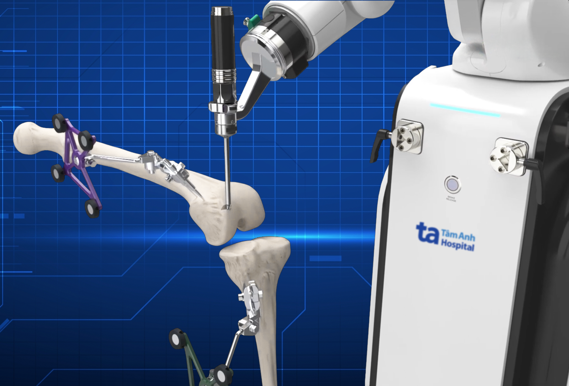 M&ocirc; phỏng robot AI chủ động cắt xương thay khớp chuẩn x&aacute;c từng milimet theo kế hoạch được b&aacute;c sĩ ph&ecirc; duyệt. Ảnh: Bệnh viện Đa khoa T&acirc;m Anh