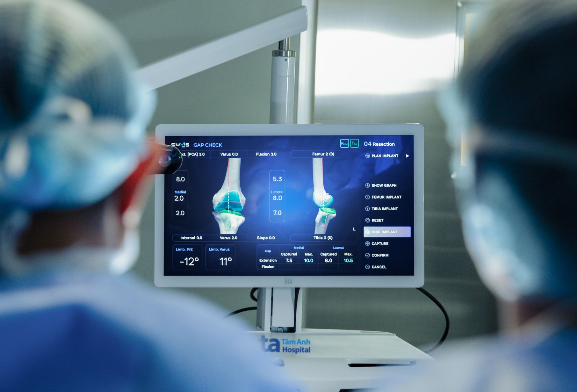 Robot CUVIS-Joint với phần mềm t&iacute;ch hợp AI gi&uacute;p b&aacute;c sĩ lập kế hoạch mổ &ldquo;si&ecirc;u nhanh&rdquo; v&agrave; dễ d&agrave;ng tinh chỉnh kế hoạch trong l&uacute;c mổ, đảm bảo độ chuẩn x&aacute;c vượt trội. Ảnh: Bệnh viện Đa khoa T&acirc;m Anh