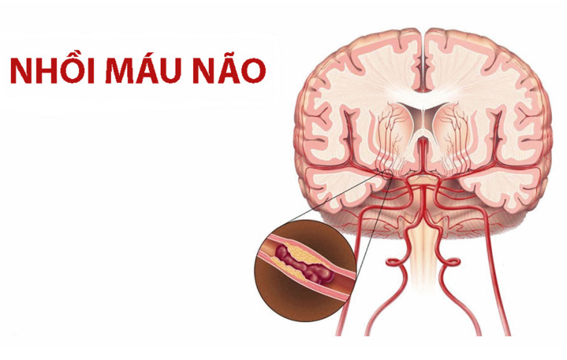 Cục m&aacute;u đ&ocirc;ng l&agrave;m tắc mạch m&aacute;u n&atilde;o g&acirc;y nhồi m&aacute;u n&atilde;o