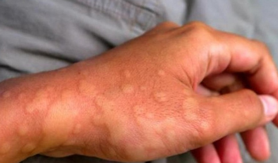 Mề đay, dị ứng bùng phát nhiều lần khiến người bệnh mệt mỏi, khó chịu Mề đay, dị ứng bùng phát nhiều lần khiến người bệnh mệt mỏi, khó chịu